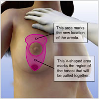 breast-lift-implants-surgery010