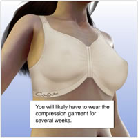 breast-lift-implants-surgery014