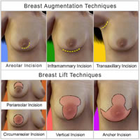 breast-lift-implants-surgery05