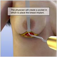 breast-lift-implants-surgery08