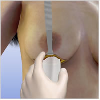breast-lift-implants-surgery09