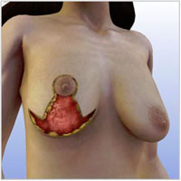 breast-lift-surgery012