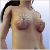 breast-lift-surgery013