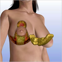 breast-reduction-surgery03