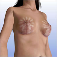 breast-reduction-surgery04