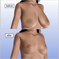 breast-reduction-surgery05
