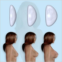 natrelle-breast-implants01