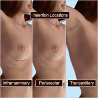 natrelle-breast-implants05