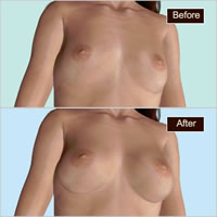 natrelle-breast-implants07