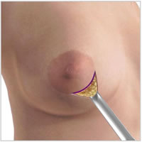 saleen-breast-implants-areola-incision04