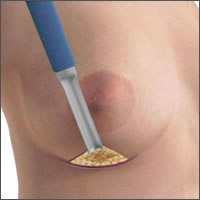 saleen-breast-implants-under-breast-incision04