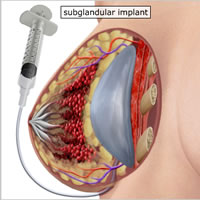 saleen-breast-implants-under-breast-incision06